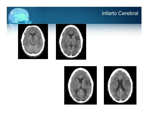 Manejo Inicial del Paciente con Enfermedad Vascular Cerebral