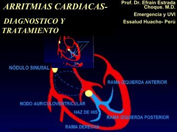 Arritmias Cardiacas: Diagnostico y Tratamiento - Reeme.arizona.edu