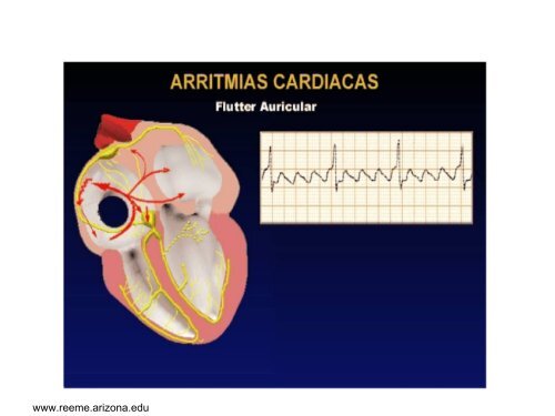 Arritmias Cardiacas: Diagnostico y Tratamiento - Reeme.arizona.edu