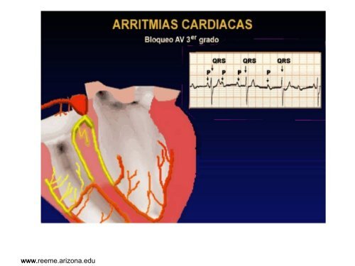 Arritmias Cardiacas: Diagnostico y Tratamiento - Reeme.arizona.edu