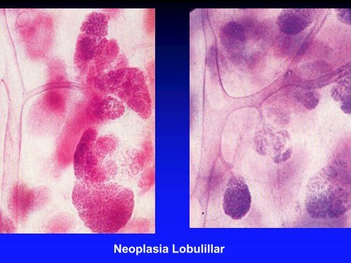 NEOPLASIA LOBULILLAR IN SITU Â¿Predictor de riesgo o lesiÃ³n ...