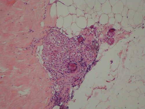 NEOPLASIA LOBULILLAR IN SITU Â¿Predictor de riesgo o lesiÃ³n ...