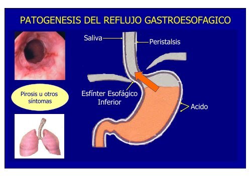 nuevos metodos de diagnostico en erge