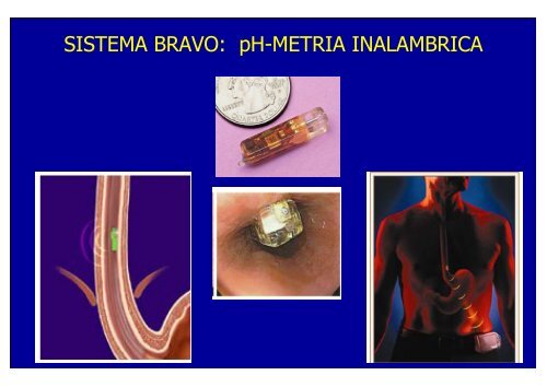 nuevos metodos de diagnostico en erge