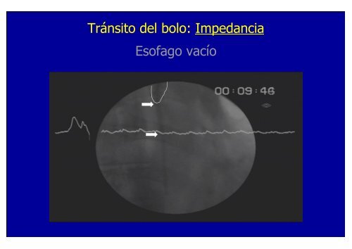 nuevos metodos de diagnostico en erge