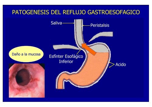 nuevos metodos de diagnostico en erge