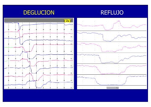 nuevos metodos de diagnostico en erge