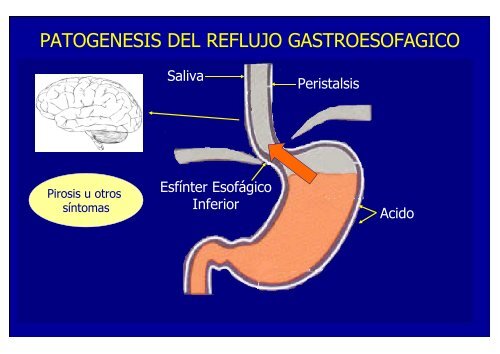 nuevos metodos de diagnostico en erge