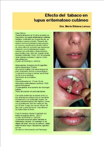 Efecto del tabaco en lupus eritematoso cutÃ¡neo - PIEL-L ...