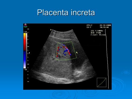 Placenta accreta - SFOG