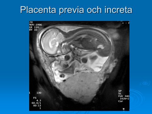 Placenta accreta - SFOG