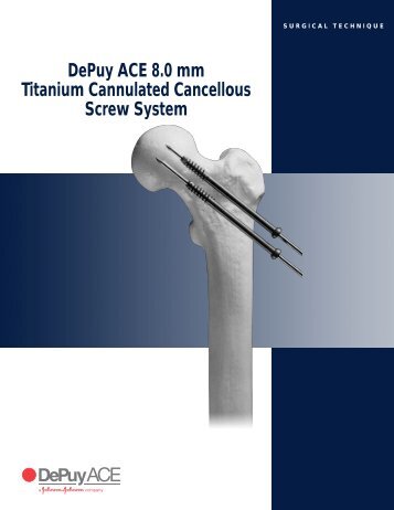 DePuy ACE 8.0 mm Titanium Cannulated Cancellous ... - Biomet