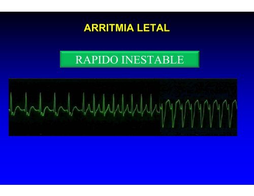 Arritmias Letales - Reeme.arizona.edu