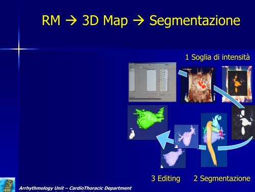 Terapia ablativa della fibrillazione atriale: l' integrazione ECO-RM ÃƒÂ¨ ...