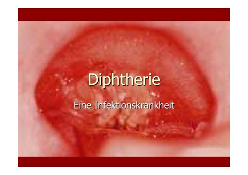 Diphtherie - Realschule-Beilngries.de