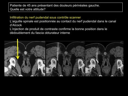 PROCÃDURES INTERVENTIONNELLES DU BASSIN :