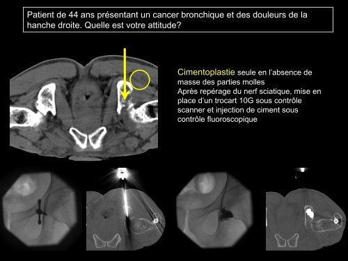 PROCÃDURES INTERVENTIONNELLES DU BASSIN :