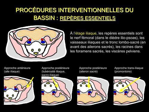 PROCÃDURES INTERVENTIONNELLES DU BASSIN :