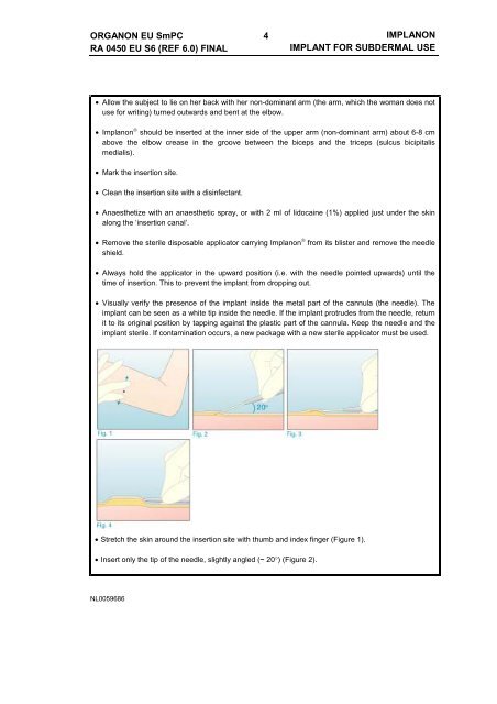 IMPLANON IMPLANT FOR SUBDERMAL USE ... - epgonline.org