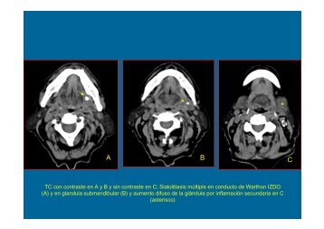 TC con contraste en A y B y sin contraste en C; Sialolitiasis múltiple ...