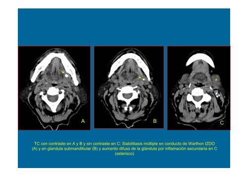 TC con contraste en A y B y sin contraste en C; Sialolitiasis múltiple ...