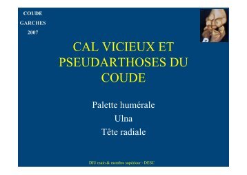 Cals vicieux et pseudarthrose - ClubOrtho.fr