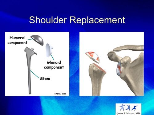 A Patient's Guide to Shoulder Pain