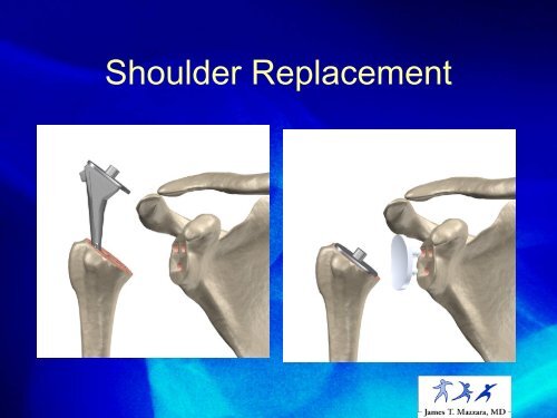 A Patient's Guide to Shoulder Pain