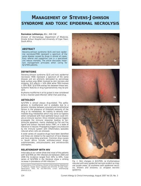 Management of Stevens- Johnson syndrome and toxic epidermal