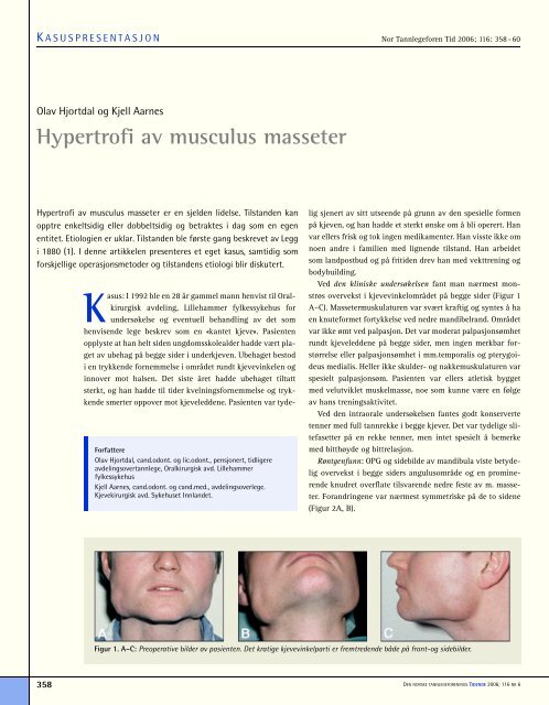 Hypertrofi Av Musculus Masseter Den Norske Tannlegeforenings 