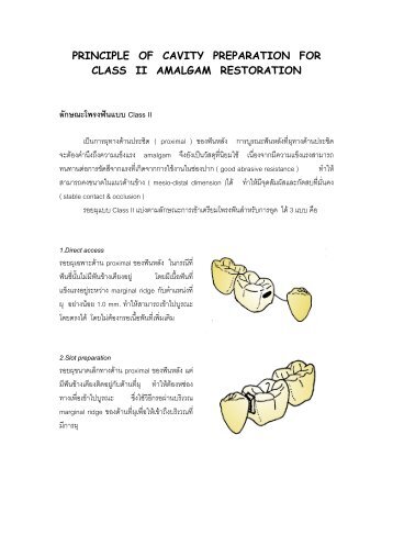 PRINCIPLE OF CAVITY PREPARATION FOR CLASS II AMALGAM ...