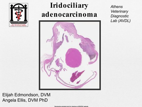 Iridociliary Adenocarcinoma