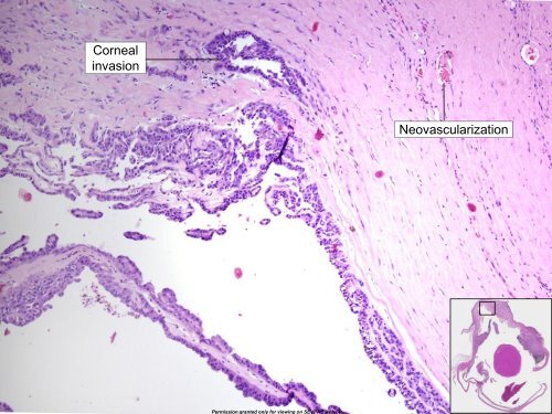 Iridociliary Adenocarcinoma