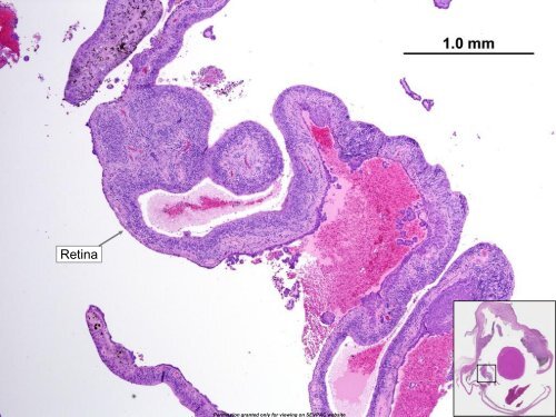 Iridociliary Adenocarcinoma