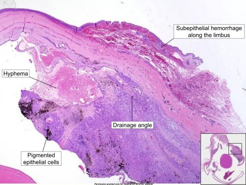 Iridociliary Adenocarcinoma