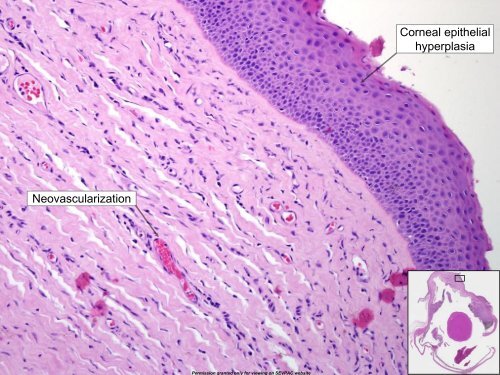 Iridociliary Adenocarcinoma