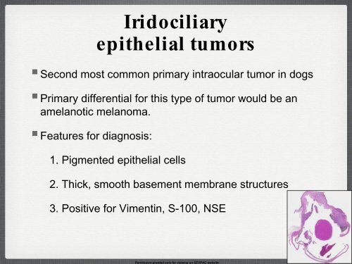 Iridociliary Adenocarcinoma