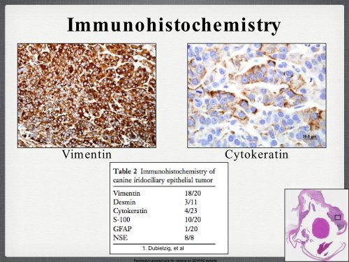 Iridociliary Adenocarcinoma