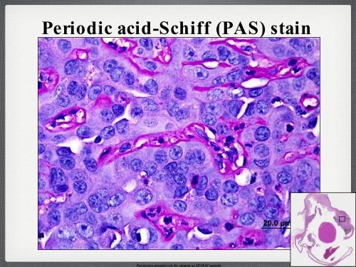 Iridociliary Adenocarcinoma