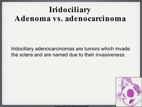 Iridociliary Adenocarcinoma