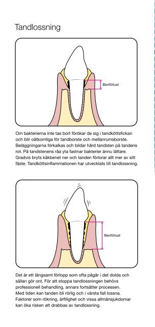 TandkÃ¶ttsinflammation och tandlossning - TePe