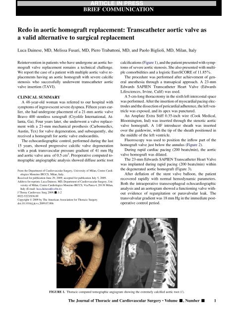 Redo in aortic homograft replacement: Transcatheter aortic valve as ...