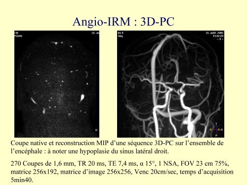 IRM 3T : ExpÃ©rience clinique initiale rennaise en Neuroradiologie
