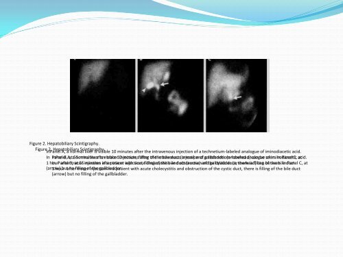 ACUTE CALCULOUS CHOLE CYSTITIS ACUTE ... - IAGH