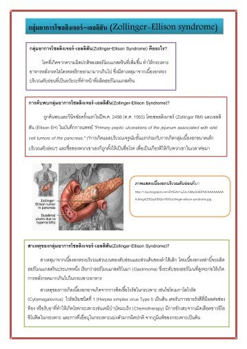 กลุ่มอาการโซลลิงเจอร์-เอลลิสัน(Zollinger-Ellison Syndrome) คืออะไร?