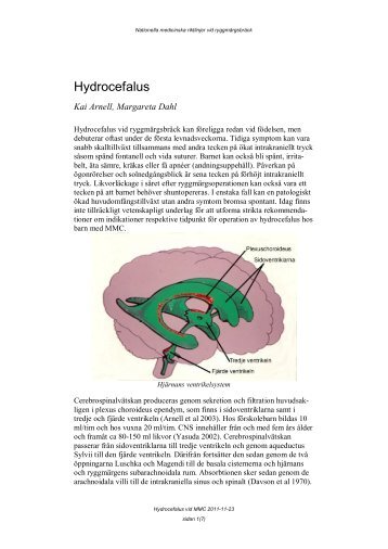 Hydrocefalus vid MMC - BLF