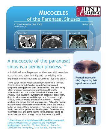 Mucoceles of the Paranasal Sinuses - ENT & Allergy Associates