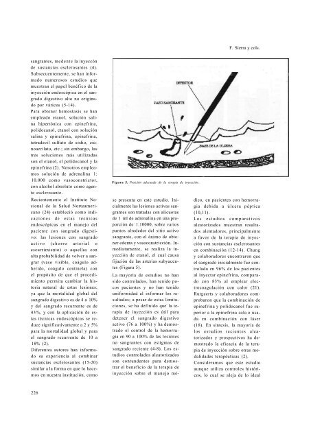 Escleroterapia en sangrado digestivo alto por úlcera péptica Estudio ...