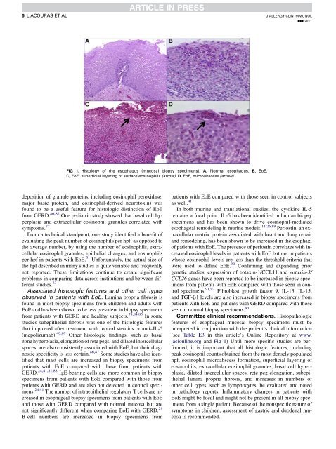 Eosinophilic esophagitis: Updated consensus ... - AInotes