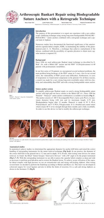 Arthroscopic Bankart Repair using Biodegradable ... - Dr. Klaus Dann